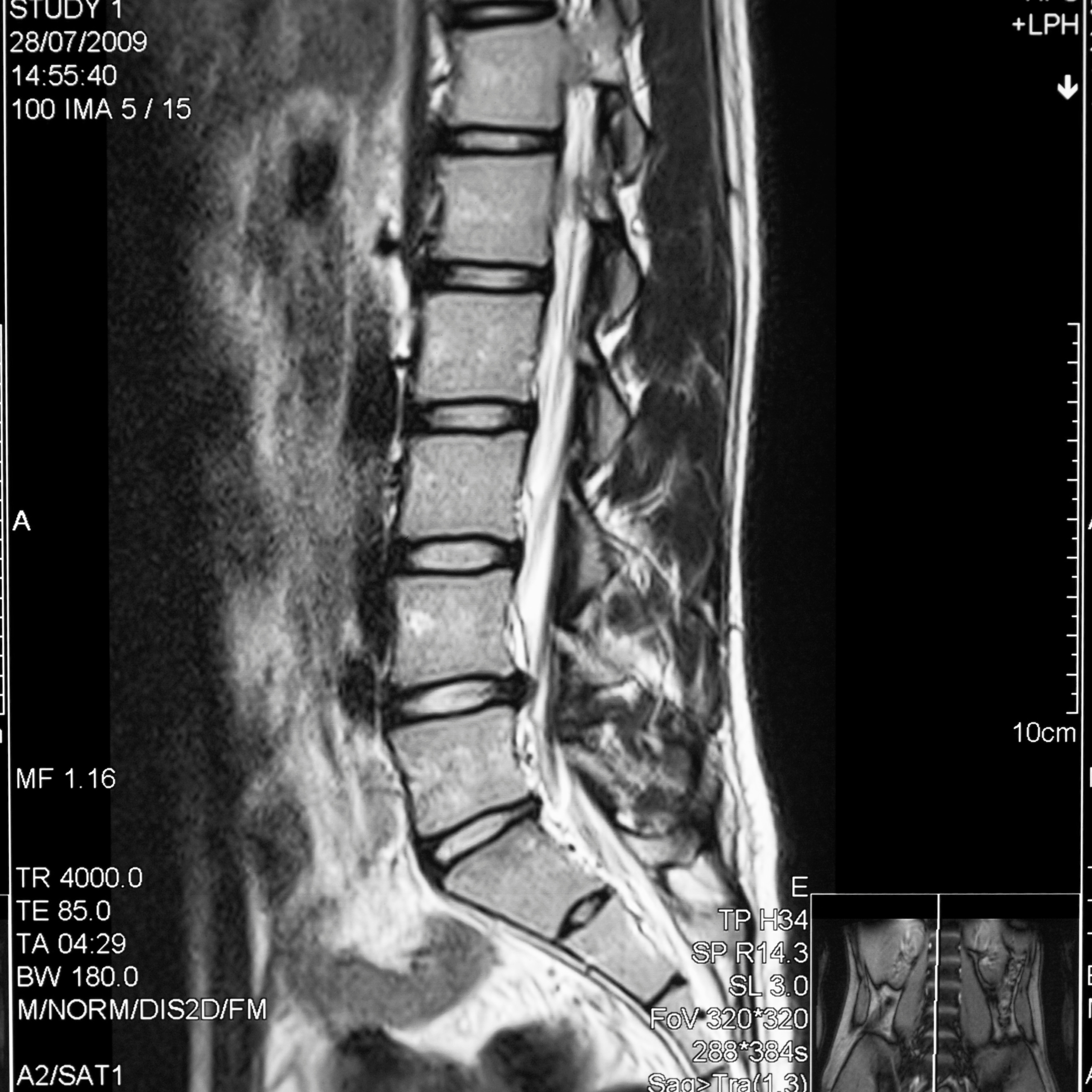 MRI-scan van de onderrug waarop een hernia tussen de wervels zichtbaar is.
